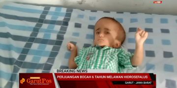 VIDEO: Kisah Alfa Muzakir Bocah Penderita Hidrosefalus di Garut Yang Butuh Uluran Tangan